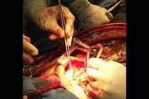 Oμιλία με θέμα: «Νεότερες εξελίξεις στην επεμβατική καρδιολογία» διοργανώνει το Πολυκοινωνικό Αλεξανδρούπολης