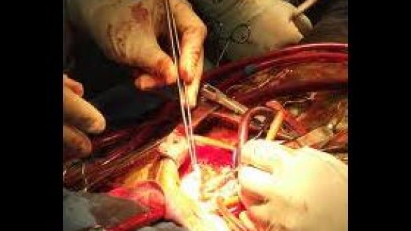 Oμιλία με θέμα: «Νεότερες εξελίξεις στην επεμβατική καρδιολογία» διοργανώνει το Πολυκοινωνικό Αλεξανδρούπολης