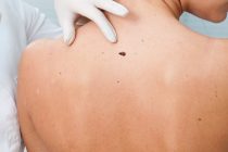 Ελληνική Εβδομάδα κατά του Καρκίνου του Δέρματος: Κάντε δωρεάν εξετάσεις