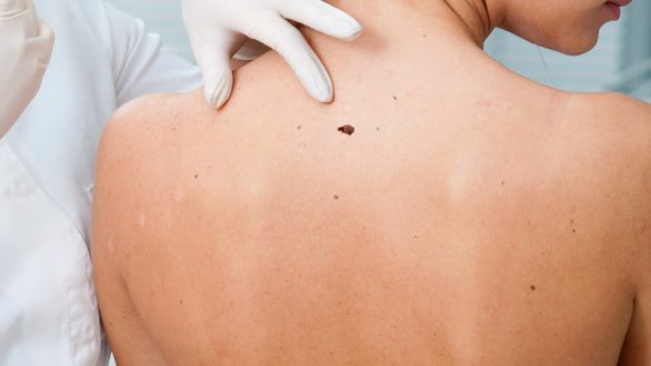 Ελληνική Εβδομάδα κατά του Καρκίνου του Δέρματος: Κάντε δωρεάν εξετάσεις