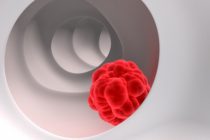 Παράγοντες κινδύνου στο ινοαδένωμα και στον καρκίνο του παχέος εντέρου