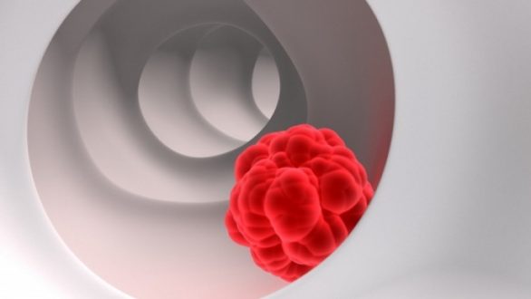 Παράγοντες κινδύνου στο ινοαδένωμα και στον καρκίνο του παχέος εντέρου