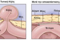 Τι είναι η κήλη και πώς μπορεί να αντιμετωπιστεί λαπαροσκοπικά