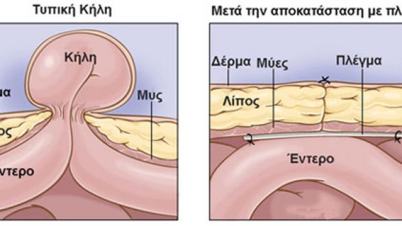 Τι είναι η κήλη και πώς μπορεί να αντιμετωπιστεί λαπαροσκοπικά