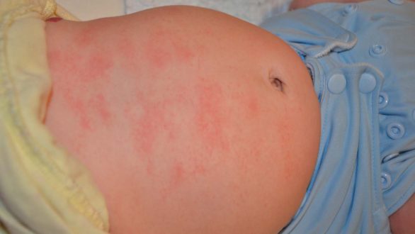 Κρούσματα ψώρας στο Διδυμότειχο