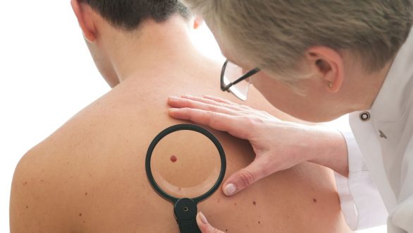 «Καρκίνος του δέρματος και Μελάνωμα: Πρόληψη και θεραπεία»