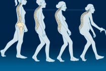 Δωρεάν έλεγχος οστεοπόρωσης από το Δήμο Ορεστιάδας