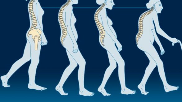 Δωρεάν έλεγχος οστεοπόρωσης από το Δήμο Ορεστιάδας