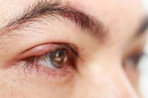 Κριθαράκι στο μάτι: Τα 5 βήματα στο σπίτι που θα σας σώσουν