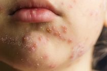 ΚΕΕΛΠΝΟ: 780 επιβεβαιωμένα κρούσματα ιλαράς στην Ελλάδα