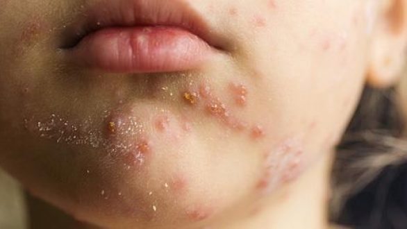 Καλπάζει η επιδημία ιλαράς με 1829 κρούσματα