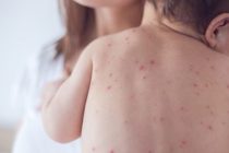 Με ιλαρά νοσηλεύτηκαν δύο παιδιά στο Νοσοκομείο Κομοτηνής