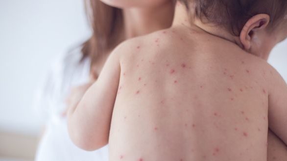 Αύξηση των κρουσμάτων ιλαράς και στη Βόρεια Ελλάδα το τελευταίο διάστημα